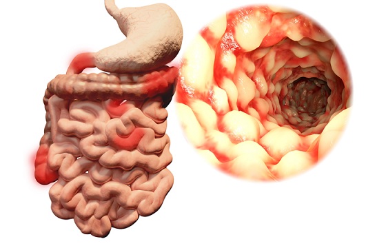 Ulcerative Colitis